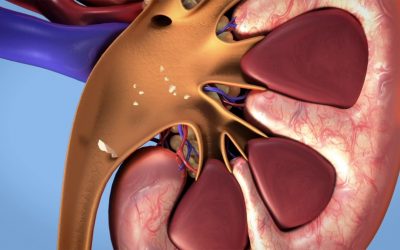 TREATMENT OF KIDNEY STONES IN NIGERIA